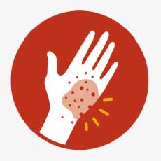 Radiation Burns